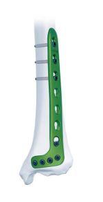 Дистально-латеральна великогомілкова пластина , ліва ( Double Medical Technology Inc.)